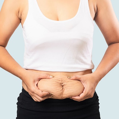Can Tummy Tuck Treatment Tighten Loose Skin