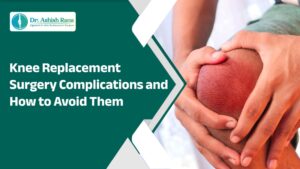 Knee Replacement Surgery Complications and How to Avoid Them
