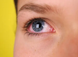 pink eye