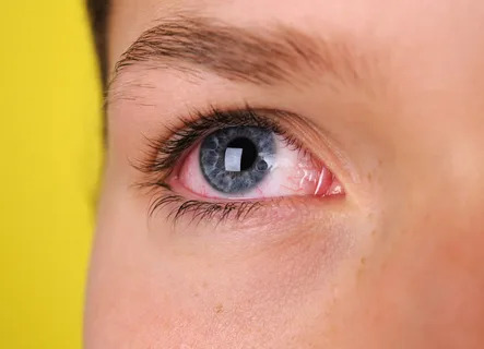 pink eye