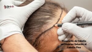 trasplante de cabello