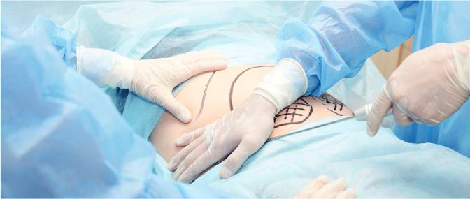 Tummy tuck in dubai