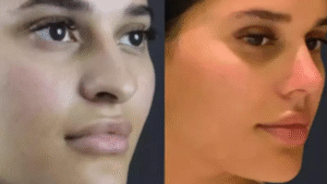 septoplasty in dubai