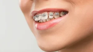 Braces