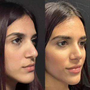 best rhinoplasty surgeon in dubai