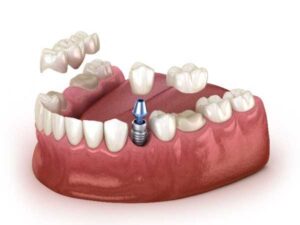 invisalign Warrington