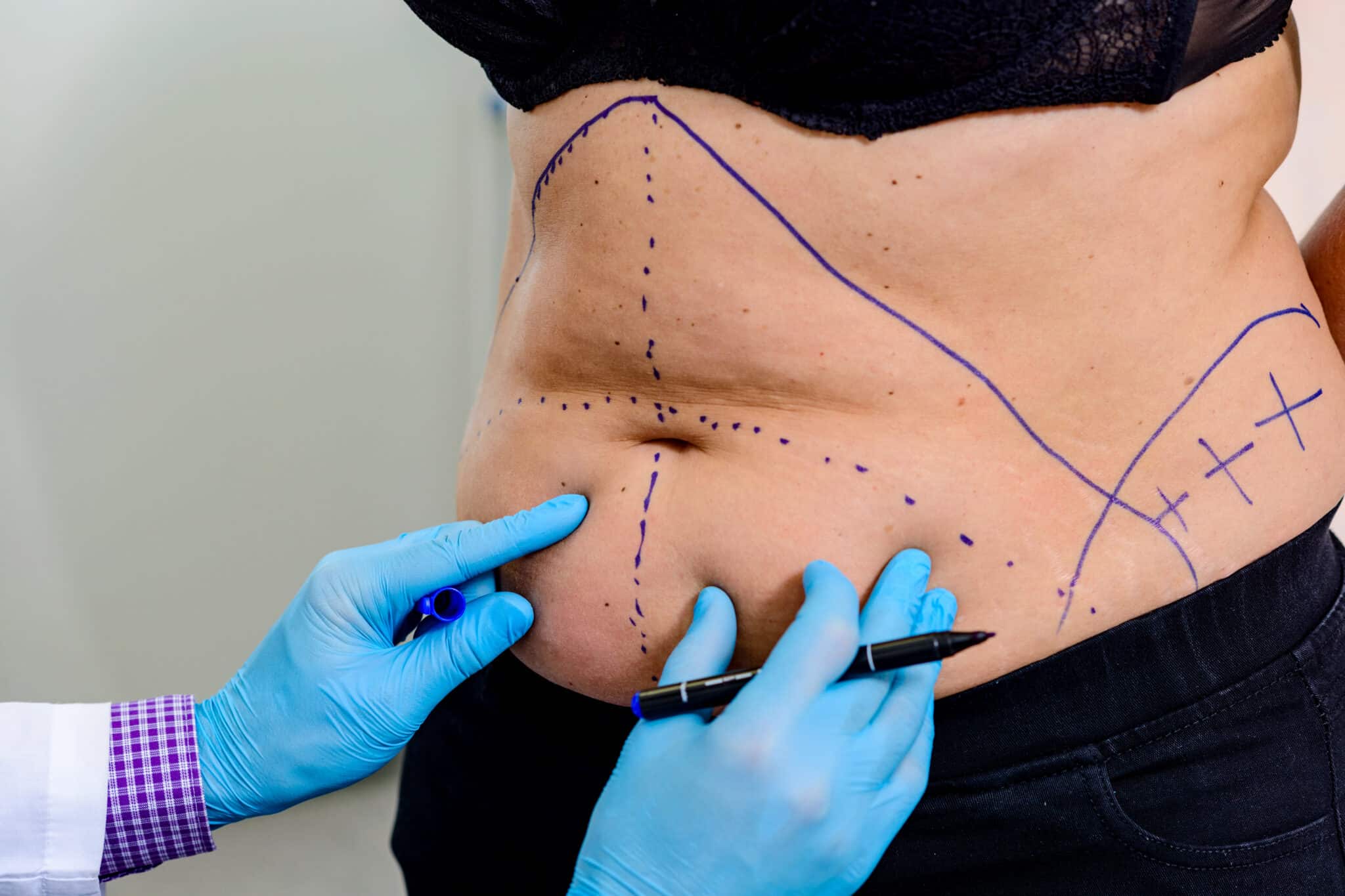 Expert Tips for Recovery After a Mommy Makeover