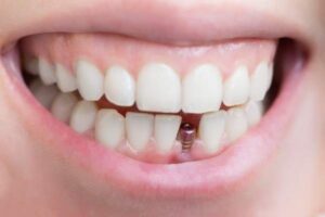 invisalign Worcester