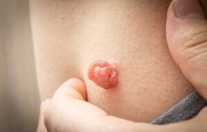 skin tags in the anus