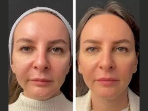 Mesotherapy treatment in Dubai