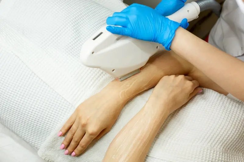 Laser Stretch Mark Removal